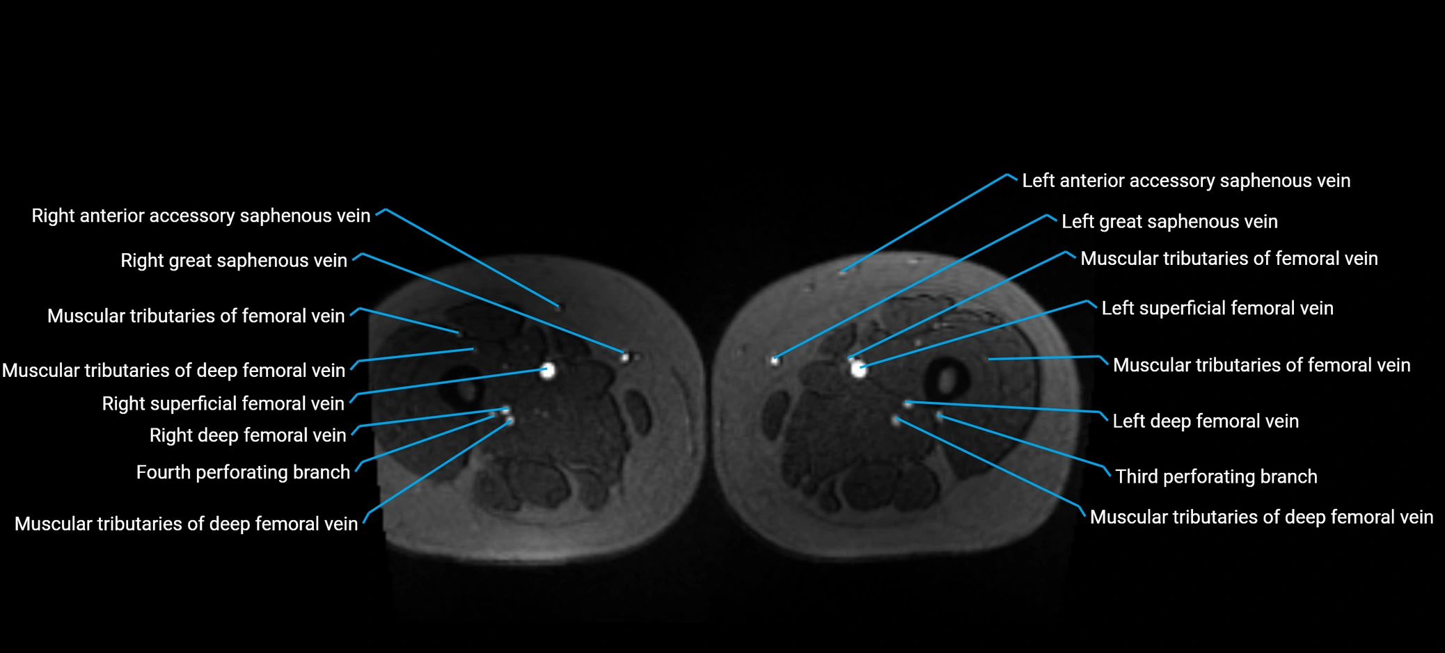 MRV abdomen pelvis & lower limb axial cross sectional anatomy labelled MRI image 257 (1).webp